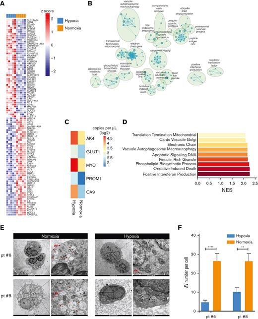 Hypoxia modulation on pd-JAO-dc. (A) Heat map showing the top 50 upregulated and downregulated genes in differential gene expression profile analysis of pd-JAO-dc maintained in hypoxic vs normoxic conditions in 5 pairs of samples. (B) Enrichment map shows the positive enriched biological process (derived from c5 GSEA-MSigDB) in pd-JAO-dc in normoxic vs hypoxic conditions. Nodes represent the functional gene sets, and the size is proportional to the size of the gene set. Edge thickness is proportional to the overlap between gene sets. Only gene sets that are enriched with an FDR < 0.05 are shown. Nodes with common biological functions were clustered by Auto Annotate Cytoscape plug-in using the MCL cluster. (C) Absolute expression of AK4, GLUT1, MYC, PROM1, and CA9 genes in pd-JAO-dc by droplet digital polymerase chain reaction analysis in both conditions. Heat map columns show the mean value of absolute copies per μL for all samples for each condition as log2. (D) Bars showing the enriched clusters of GSEA of top gene sets positively enriched in normoxic conditions compared with hypoxia. X-axis normalized enriched score (NES) value. (E) TEM images of fixed tBM pd-JAO systems after 5 days from the generation for 2 patients. Degraded mitochondria showed characteristic swellings, large portions of empty matrix, inside it are recognizable residues of cristae, and the double membrane is clearly visible. An autophagic body can be larger than a mitochondrion and inside of it, we can appreciate reticulum residues membranes and vesicles. Red arrow indicates an example of AVs in the cells. Scale bar, 2 μm and 500 nm, left and right respectively for both hypoxia and normoxia. (F) Number of AVs counted in the pd-JAO TEM section (hypoxia, N = 12 for patient #6 and N = 12 for patient #8, normoxia N = 11 for patient #6 and N = 7 for patient #8). Mean and SEM are shown. ∗∗P ≤ .01, ∗∗∗∗P ≤ .0001 by 2-tailed unpaired t test. AV: autophagic vesicles; M: mitochondria; N: nuclei.