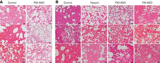 FXII depletion appears to limit ECMO-related lung pathology. Shown are representative H&E-stained sections of lung tissue harvested immediately after termination of ECMO. (A) Lung tissue from 3 of the 4 control rabbits (the remaining animal was not evaluated because of problems related to tissue processing) in the heparin/protamine cohort had evidence of significant interstitial hemorrhage and edema. In contrast, lung tissue harvested from the 4 FXII ASO-treated animals was relatively intact. (B) Lung tissue from control rabbits in the citrate/calcium cohort paralleled findings in the heparin/protamine cohort with significant interstitial edema and hemorrhage. Lung tissue from the FXI-depleted and heparin-treated animals in this cohort had more moderate evidence of interstitial edema/hemorrhage. In contrast, only 1 of the 4 FXII ASO-treated rabbits in this cohort had evidence of edema (bottom panel). Several of the lungs had evidence of capillary congestion (indicated by an asterisk), a common finding in ECMO. Scale bars, 50 μm; original magnification ×100.