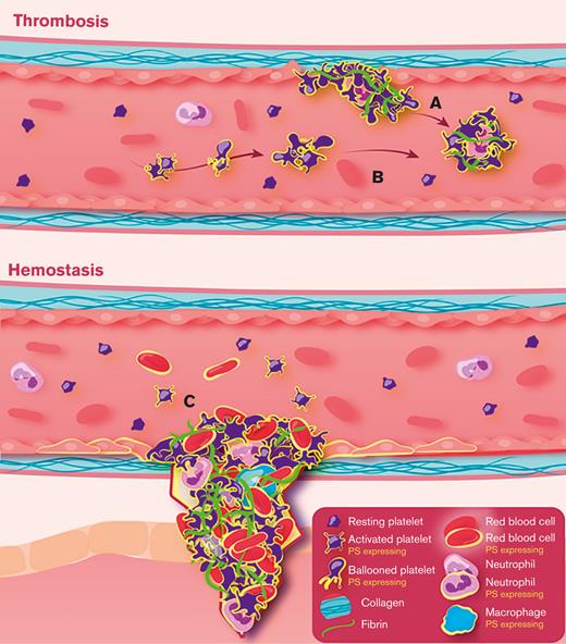 Platelet PMDs in hemostasis and thrombosis. (A) Thrombosis occurs at sites of breached endothelium, leading to exposure of subendothelial collagen, platelet GPVI activation, platelet hemostatic plug formation, membrane ballooning, microvesiculation, and PS exposure (top). (B) Thrombus formation may also occur intravascularly because of platelet-matrix protein interaction, a process more likely to occur in venous beds, leading to deep vein thrombosis.14,15 Here, soluble and/or diffusible platelet agonists may activate platelets and lead to thrombosis intravascularly without substantial vessel injury. In panels A-B, thrombin may feed back on the platelets to further potentiate PS exposure, leading to further thrombin generation. (C) A stable hemostatic plug is formed after injury, which markedly exposes the subendothelial matrix. In addition to activated and ballooned platelets, support for hemostasis is provided via the release or generation of tissue factors and by nonplatelet sources of PS; namely, red blood cells,16-19 macrophages,20,21 neutrophils,22 monocytes,21,23 and cells of the vessel intima layer,24-27 which are also able to expose PS and present catalytic surfaces for localized thrombin generation.
