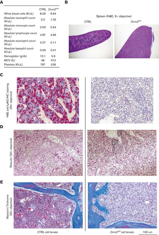 Hematological findings in an old distressed Dnm2het mouse. CBC findings in a distressed old female Dnm2het mouse. One old distressed female Dnm2het mouse had severe cytopenia (A) and a marked splenomegaly (B). Its BM was entirely effaced by immature myeloid precursors (C). Special stains were performed. Ly6G staining (C) was dramatically reduced. Reticulin staining (D) and Masson’s trichome staining (E) showed early fibrotic changes in the BM of this distress old Dnm2het mice. Histology slide images were captured using the Aperio AT2 slide scanner at 20X or the CRI Nuance Spectral Imaging microscope, unless specified otherwise.