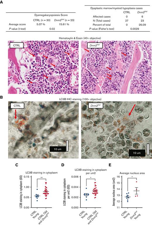 BM dysplastic feature analysis and autophagy marker LC3B staining pattern in older female Dnm2het mice. (A) BM dysplastic morphology analysis in female and Dnm2het CTRL mice. After 50 weeks of age, 26% of Dnm2het mice (out of N = 23), but no CTRL mice, displayed marrow dysplasia. On hematoxylin & eosin stain, with red arrows indicating megakaryocytes, Dnm2het mice show frequent dysmorphic megakaryocytes with small and hyposegmented nuclei with a scant amount of cytoplasm, whereas CTRL mice showed normal segmented megakaryocytes with variable amounts of cytoplasm. Histology slide images were captured using the Aperio AT2 slide scanner at 20X or the CRI Nuance Spectral Imaging microscope, unless specified otherwise. (B) Autophagy marker LC3B pattern in older female Dnm2het mice (>34 weeks of age). For imaging of LC3B cluster dots, we used an Olympus BH2 microscope with a 100X objective, NA 1.3, and Olympus C-35AD-2 camera. Additional nonlinear adjustments such as changes to gamma settings using the Photoshop software were applied to improve discernibility on the digital images. Autophagy marker LC3B stained dotted clusters were more conspicuous and more readily observed in the cytoplasm in the BM of young CTRL (<34 weeks of age) than in the BM in the other groups (old CTRL above 34 weeks combined with Dnm2het all ages). (C,D) Halo Image analysis of the average cytoplasm LC3B staining in different mouse groups. The average cytoplasm LC3B staining was lower in the young CTRL (<34 weeks) than in other groups taken together (old CTRL above 34 weeks plus Dnm2het all ages), N = 8 and above. (E) Halo Image analysis of the average nuclear size in young Dnm2het females (<34 weeks) than in young CTRL females (<34 weeks). The average nuclear size was greater in young Dnm2het females than in young CTRL females, N = 4 and above. Data are shown as mean +/− SEM. ∗P < .05, ∗∗P < .01, t-test.