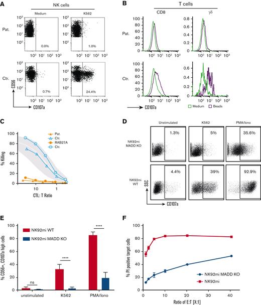 Reduced degranulation and cytotoxicity of MADD-deficient patient cells and knockout cells. (A-C) Patient cells compared with healthy control cells. (A-B) Degranulation of fresh NK cells after stimulation with K562 cells (A) and of d3 PHA/IL-2–activated CD8 T cells, and γδ T cells stimulated with anti-CD3/CD28 beads (B) as detected by upregulation of CD107a. (C) Defective cytotoxicity of patient d12 PHA/IL-2 blasts from the patient, a patient with RAB27A deficiency and 2 healthy donors on L1210 targets in a 51Cr redirected lysis assay. The gray area indicates mean ± SD of a cohort of 25 healthy donors. Assays with patient cells were repeated twice with similar result. (D-F) NK-92mi MADD knockout cells vs NK-92mi wild-type cells. (D) Representative plot of reduced degranulation after stimulation with K562 or PMA/ionomycin. (E) Significantly lower proportion of degranulated NK-92mi MADD knockout cells after stimulation than that of wild-type cells (3 test series with triplicates each, P < .0001). (F) Defective cytotoxicity in a flow cytometric assay, reported as the proportion of propidium iodide (PI)–positive cells.