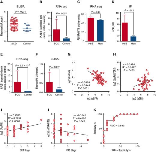 PsuPAR levels correlate with stages of CKD in patients with SCD. (A) PsuPAR levels for patients with SCD without CKD (n = 44) and patients without SCD as healthy control participants (n = 8). Results for each patient and means for groups are shown. (B) PLAUR expression determined by RNA-seq in activated PBMCs collected from patients with SCD (n = 9) and non-SCD healthy control participants (n = 9). (C) PLAUR expression determined by RNA-seq in THP-1–derived macrophages treated with either sickle (HbS) or healthy (HbA) human hemoglobin for 24 hours (n = 2). (D) Quantification of immunofluorescent (IF) staining of uPAR in THP-1–derived macrophages treated with mutated HbS or normal hemoglobin (HbA) for 72 hours. 4′, 6-diamidino-2-phenylindole (DAPI) is used for nuclear staining. Results are normalized for DAPI (n = 3). (E) GPLD1 expression determined by RNA-seq in PBMCs collected from patients with SCD (n = 6) and patients without SCD as healthy control participants (n = 6). (F) Plasma uPA activity determined by enzyme-linked immunosorbent assays in patients with SCD (n = 13) and healthy control participants (n = 10). (G) Pearson correlation analysis of plasma log2 (PsuPAR) with log2 (eGFR) in patients with SCD (n = 77). (H) Pearson correlation analysis of urine log2 (UsuPAR/CRE) with log2 (eGFR) in patients with SCD (n = 44). (I) Pearson correlation analysis of plasma log2 (PsuPAR) with CKD stages in patients with SCD (n = 77). (J) Pearson correlation analysis of urine log2 (UsuPAR/CRE) with CKD stages in patients with SCD (n = 44). (K) Receiver operating characteristic analysis of PsuPAR shown for patients with SCD with stages 1 (n = 18) vs stages 2 to 4 (n = 10). Correlation and receiver operating characteristic were performed using GraphPad Prism 6. Results are shown as mean ± standard deviation. P < .05 was considered statistically significant. AUC, area under the curve; CRE, creatinine; MFI, mean fluorescence intensity; PsuPAR, plasma suPAR; UsuPAR, urine suPAR.