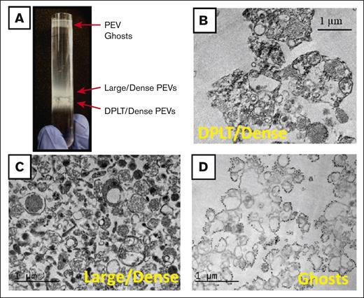 Ultrastructural analysis of PSLPs isolated by density gradient. (A) PSLPs from apheresis PLTs stored for 7 days float in a sucrose density gradient in 3 distinct populations. TEM images of PSLP population collected at (B) d = 1.14 to 1.17 g/mL band composed of DPLT and dense PEVs, (C) d = 1.09 to 1.13 g/mL band composed of large/dense PEVs, and (D) d = 1.02 to 1.06 g/mL composed of ghosts PEVs: membranous vesicles that float to the top of the density gradient. Apheresis PLTs were centrifuged at 1000 g for 30 minutes; the supernatant containing the PSLPs was fixed with 1% paraformaldehyde, pelleted (30 000 g for 20 minutes), and subjected to a sucrose density gradient for 14 hours.