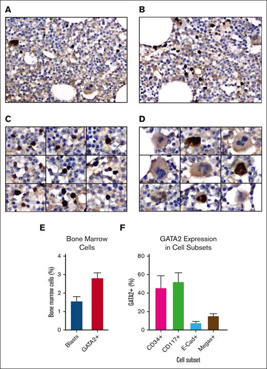 GATA2 IHC in benign adult bone marrow. (A-B) Representative fields of GATA2 IHC in adult bone marrow (DAB and hematoxylin; original magnification ×400). (C) GATA2+ mononuclear cells (DAB and hematoxylin; original magnification ×400). (D) Representative megakaryocytes, showing both GATA2+ and GATA2− examples (DAB and hematoxylin; original magnification ×400). (E) Percent bone marrow blasts and percent GATA2+ bone marrow mononuclear cells (n = 10). (F) Percent of representative cells positive for indicated marker, which are also GATA2+ by dual IHC (n = 5). Error bars = standard error of the mean (SEM).