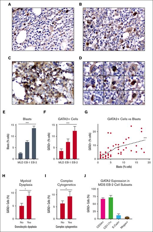 GATA2 IHC in adult MDS. (A-C) Representative fields of GATA2 IHC in adult MDS bone marrow involved by (A) MDS-multilineage dysplasia (MLD), (B) MDS-EB1, and (C) MDS-EB2 (DAB and hematoxylin; original magnification ×400). (C) GATA2+ mononuclear cells in MDS-EB2 (DAB and hematoxylin; original magnification ×400). (D) Representative megakaryocytes in MDS, showing both GATA2+ and GATA2− examples (DAB and hematoxylin; original magnification ×400). (E-G) Percent bone marrow blasts and percent GATA2+ bone marrow mononuclear cells (n = 47). (H-I) Relationship between GATA2+ cells and (H) myeloid dysplasia (n = 46) and (I) complex cytogenetics (n = 47) in MDS. (J) Percent of representative cells positive for indicated marker, which are also GATA2+ by dual IHC in MDS-EB2 (n = 5). Error bars = SEM; ∗P < .05 and ∗∗∗P < .005.