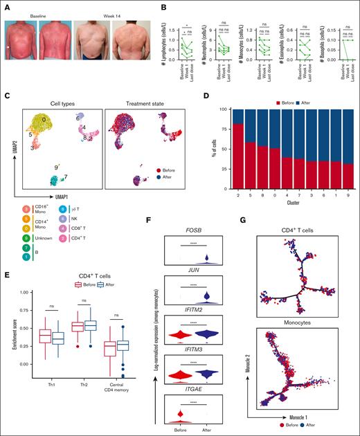 Single-cell analysis of immune cells among patients with SS before and after the combination treatment with anti-CCR4 and IFN-α2a. (A) Representative clinical images at baseline and 14 weeks after initiating dual therapy with IFN- α2a and mogamulizumab. (B) Kinetics of peripheral immune cells for the indicated time relative after initiating dual therapy. (C) UMAP representations of integrated single-cell transcriptomes derived from the peripheral blood before and after treatment with anti-CCR4 and IFN-α2a. (D) Bar plots of the proportion of each cluster identified in panel B before and after treatment with anti-CCR4 and IFN-α2a. (E) Box plots comparing enrichment scores for the indicated phenotype among CD4 T cells before and after treatment with anti-CCR4 and IFN-α2a. Center line, median; box limits, upper and lower quartiles. (F) Log-normalized expression of the indicated genes among monocytes before and after treatment with anti-CCR4 and IFN-α2a. (G) Single-cell trajectory plot showing lineage relationships among monocytes before and after treatment with anti-CCR4 and IFN-α2a using the Monocle algorithm. ns, nonsignificant.