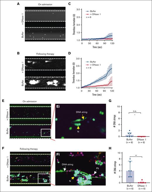 Platelets are required for the formation of NETs under flow in whole-blood samples of acute iTTP. (A-B) Representative images illustrate adhered neutrophils and platelets on a collagen-coated surface following perfusion of a whole blood sample from patients with iTTP on admission and after therapy, respectively, with or without DNase I (200 IU/mL) as indicated. (C-D) The rate of thrombus formation as a function of time (mean ± SEM, n = 6) following perfusion of iTTP blood samples collected on admission and after therapy, respectively, with or without DNase I (200 IU/mL) as indicated. (E-F) Final platelets, leukocytes, and DNA strings on a collagen surface following perfusion, fixation, and restained with anti-CD41 APC and SytoxGreen with or without DNase I as indicated. (Ei-Fi) Enlarged (5×) areas of the bottom images in E and F, respectively, indicate the extracellular DNA strings, platelets (PLT), and neutrophils (N). (G-H) The number of DNA strings formed on a collagen surface following perfusion of blood samples collected from patients with iTTP on admission and during remission, respectively, with or without DNase I. Data are shown as median (bar) and IQR. Mann-Whitney test was used to determine differences. N, neutrophil; PLT, platelet; n.s. and ∗∗ indicate P > .05 and P < .01, respectively.