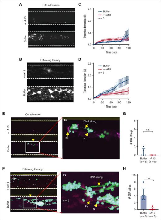 Recombinant ADAMTS13 prevents NET formation under flow in iTTP. (A-B) Representative images illustrating the final coverage of neutrophils and platelets on a collagen-coated surface following perfusion of whole blood samples from iTTP on admission and after therapy, respectively, with or without recombinant ADAMTS13 (6 μg/mL) under flow. (C-D) The rate of thrombus formation (mean ± SEM) as a function of time after perfusion of whole blood samples of iTTP on admission and following treatment, respectively, with or without rADAMTS13 under flow. (E-F) Representative confocal fluorescent images show platelets (purple), neutrophils (green), and extracellular DNA strings (elongated green) following perfusion of whole blood samples from iTTP on admission and following therapy, respectively, with or without rADAMTS13, following fixation and restaining. (Ei-Fi) Enlarged areas (5×) from E and F, respectively, indicate extracellular DNA strings, platelets, and neutrophils, respectively. (G-H) The number of elongated DNA strings formed at the end of perfusion of whole blood samples from iTTP on admission and following therapy, respectively, with or without rADAMTS13 (n = 5). The data shown are median (bar) and IQR. Mann-Whitney test was used for the differences. n.s. and ∗∗ indicate P > .05 and P < .01, respectively. rA13, recombinant ADAMTS13; N, neutrophil; PLT, platelet; SEM, standard error of the mean.