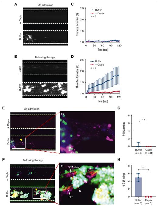 Caplacizumab also prevents the formation of NETs under flow in iTTP. (A-B) Representative images illustrating the final coverage of neutrophils and platelets on a collagen-coated surface following perfusion of whole blood samples from iTTP on admission and after therapy, with or without caplacizumab (3 μg/mL). (C-D) The rate of thrombus formation (mean ± SEM) (n = 3) as a function of time in the blood samples of iTTP on admission and after treatment, respectively, under flow with or without caplacizumab. (E-F) Representative microscopic images show the staining of platelets (purple), neutrophils (green), and extracellular DNA strings (elongated green) following perfusion of whole blood samples from iTTP on admission and following therapy, respectively, with or without caplacizumab, after fixation and restaining with anti-CD41 and SytoxGreen. (Ei-Fi) Enlarged areas (5×) from E and F, respectively, indicate extracellular DNA strings, platelets, and neutrophils. (G-H) The number of elongated DNA strings (mean ± SEM) (n = 3) formed at the end of perfusion of whole blood samples from patients with iTTP on admission and after treatment with or without caplacizumab. The data shown are median (bar) and IQR. Mann-Whitney test was used for the differences between the 2 groups. Capla, caplacizumab; N, neutrophil; PLT, platelet; n.s. and ∗∗ indicate P > .05 and P < .01, respectively.