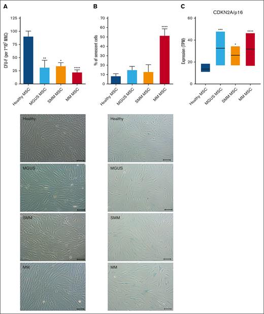 Alteration in morphology and reduced growth capacity of MGUS, SMM and MM MSC. (A) Bar charts of CFU-F were normalized to 1 × 107 plated BM-MNC and representative micrograph of the phenotype of MGUS-, SMM- and MM-derived MSC with scale bars indicating 100 μm. (B) Bar charts of the number of senescent cells in native MGUS-, SMM- and MM-derived MSC in passage 3 cells after the β-galactosidase staining and representative micrographs to visualize senescent cells in blue (scale bars indicating 100 μm). For all experiments results are expressed as mean ± SEM. Asterisks indicate P-values ∗P < .05, ∗∗P < .01, ∗∗∗P < .001. (C) Box plot of the TPM (Transcripts per Kilobase Million) values for CDKN2A (p16) from our RNA sequencing data of healthy (n = 5), MGUS (n = 4), SMM (n = 4) and MM (n = 5) MSC. Significances were included from the DESeq2 results of CDKN2A of MGUS, SMM and MM MSC contrasted to healthy MSC. Asterisks indicate P-values ∗P < .05, ∗∗P < .01, ∗∗∗P < .001, ∗∗∗∗P < .0001.