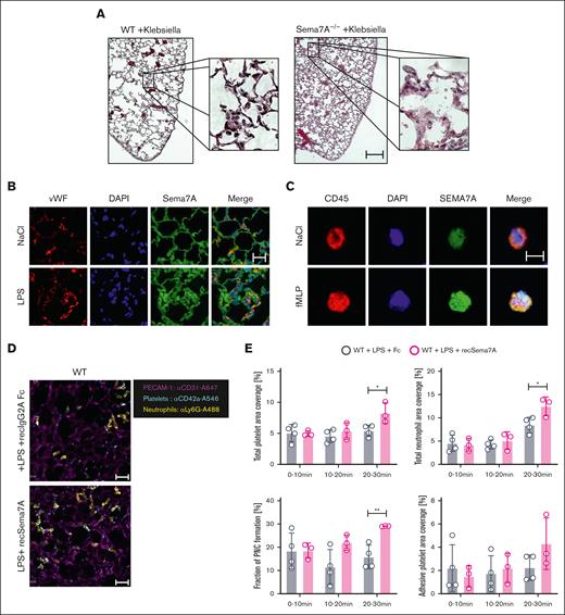 Sema7A is required for neutrophil adhesion and migration during inflammation. (A) Histological cross-sections and magnifications of lung tissue from WT and Sema7A−/− mice 24 hours after the instillation of 4 × 107 cells of K pneumoniae (scale bar, 200 μm). (B) IF staining of Sema7A (green) and vWF (red) in endothelial cells of murine lung tissue and nuclear staining with DAPI (4′,6-diamidino-2-phenylindole; blue; scale bar, 20 μm). (C) IF staining showing Sema7A expression (green) on the surface of human CD45-marked PMNs, (red) treated with NaCl or fMLP for 15 minutes (scale bar, 10 μm). (D) Representative video images of PNCs in murine lungs after LPS instillation with additional recombinant Sema7A or IgG2A-Fc (controls) treatment after 30 minutes (scale bar, 30 μm). (E) Total neutrophil area coverage, total and adhesive platelet area coverage, and the fractions of PNCs formed in the lung as determined via intravital confocal microscopic analysis of the lung in WT mice instilled with 5 μg/g BW LPS, with or without additional treatment with recombinant Sema7A (the data are the mean ± SD). ∗P < .05; ∗∗P < .01; ∗∗∗P < .001 as indicated. Fc, control fragment; IF, immunofluorescence; vWF, von Willebrand Factor.