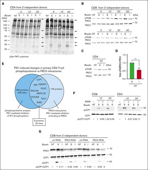 PD1 triggering inhibits binding and phosphorylation of proteins by PKCθ. (A) Western blot monitoring phosphorylation of PKC substrates on serine residues embedded within the pentapeptide motif K/R-X-pS-hydrophobic aa-K/R in lysates of human primary CD4 T cells from 2 independent donors. Cells were left untreated (NT) or triggered for the indicated time points with stimulatory (S) or inhibitory (I) beads. Arrows indicate protein bands that show reduced phosphorylation upon treatment with inhibitory beads. (B,C) Western blot monitoring PKCθ phosphorylation at T538 and total PKCθ levels in lysates of human primary CD8 from 2 independent donors (B) and CD4 (C) T cells. Cells were left NT or triggered for the indicated time points with S or I beads. (D) Quantification of experiments performed as in panels B,C: pT538 PKCθ levels in human primary T cells were normalized to total PKCθ levels for the 30-minute condition for 3 independent experiments. Mean values ± SEM. Statistical analysis was performed with a 2-tailed, unpaired t test. ∗∗P < .01. (E) Venn diagram graphically representing results of the PKCθ interactome and phosphoproteome analyses: 171 proteins underwent a significant PD1-mediated reduction in serine or threonine phosphorylation (dark blue circle), 253 proteins bound less well or did not bind to PKCθ upon PD1 triggering (light blue circle). The overlapping section contains 9 cytoskeleton proteins that show a significant decrease in serine phosphorylation and decreased binding to PKCθ upon PD1 triggering compared with the stimulating condition. (F) Western blot monitoring the effect of pretreatment with the pan-PKC inhibitor BIM8 on the phosphorylation of S5 of L-plastin (pLCP1) in human primary CD4 and CD8 T cells. Cells were pretreated as indicated for 1 hour, followed by triggering with S beads for the indicated times. Two representative blots of 3 independent experiments are shown. Densitometry analysis: the relative ratio of pLCP1 to total LCP in the samples is indicated below. (G) Western blot monitoring phosphorylation of S5 of L-plastin (pLCP1) in human primary CD8 T cells from 2 independent donors, nucleoporated with PKCθ-specific or Ctrl siRNAs. Seventy-two hours after nucleoporation, cells were triggered for 30 minutes with S or I beads. The relative ratio of pLCP1 to total LCP in the samples is indicated below.