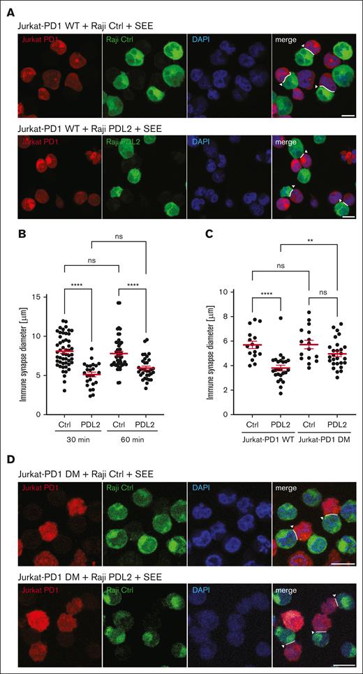 PD1 triggering decreases IS size through inhibition of PKCθ recruitment. (A) Assessment of the effect of PD1 triggering on the size (maximal diameter of the contact zone) of the IS. Jurkat-PD1-NFAT cells (labeled with CMTMR) were incubated with Raji Ctrl and Raji PDL2 cells (labeled with CFSE in presence of 6 ng/mL SEE), at a 1:1 cell ratio for 30 minutes at 37°C to facilitate IS formation. Image data from representative experiment, highlighting quantified IS by white arrowheads. Representative images of 2 independent experiments are shown. (B-C) Quantification of the size of the IS formed as described in panel A, using Jurkat-PD1-WT or DM cells (B) or Jurkat-PD1-WT cells, at different time points of incubation with Raji Ctrl and Raji PDL2 cells (C). Representative results of 2 and 3 independent experiments, respectively, are shown. Each dot represents a value from 1 Jurkat cell, (B) 51, 26, 50 and 33 cells; (C)16, 25, 16 and 27 cells were quantified, respectively. (D) Assessment of the effect of PD1 triggering on the size (maximal diameter of the contact zone) of the IS. Jurkat-PD1-WT and Jurkat-PD1-DM cells (labeled with CMTMR) were incubated with Raji PDL2 cells (labeled with CFSE in presence of 6 ng/mL SEE), at a 1:1 cell ratio for 30 minutes at 37°C to facilitate IS formation. Image data from representative experiments, highlighting quantified IS by white arrowheads. Representative images of 3 independent experiments are shown. Scale bar, 10 μm. Graphs in panels B-C show mean value ± SEM. Statistical analysis was performed using 1-way ANOVA with Šídák’s multiple comparisons test. ∗∗∗∗P < .0001; ∗∗P < .01; ns, not significant.
