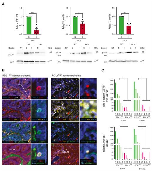 PD1 induces long-lasting dephosphorylation of cytoskeleton proteins in vitro and in human lung adenocarcinoma tissues. (A) Western blot analysis monitoring phosphorylation of S5 of L-plastin (pS5 LCP1), S39 of vimentin (pS39 Vim), and S72 of vimentin (pS72 Vim) in human primary CD4 T cells. Cells were left untreated (NT) or triggered for the indicated time points with stimulatory (S) or inhibitory (I) beads. Quantification of the signal at 24 hours was performed by normalization of the phosphorylation signal to the signal of nonphosphorylated total proteins and calculated for 4 (pS39 Vim) and 5 independent experiments (pS5 LCP1 and pS72 Vim). Mean value ± SEM. Statistical analysis was performed using a 2-tailed, unpaired t test. ∗P < .05; ∗∗∗P < .001; ∗∗∗∗P < .0001. (B) Immunohistochemistry staining of human lung adenocarcinoma tissue samples characterized by low or high PDL1 expression. Samples where fluorescently labeled for PanCK, PDL1, PD1, CD3 and pS39 Vim. Nuclei were visualized with DAPI. Insets show intratumoral CD3+ lymphocytes, positive for PD1, coexpressing pS39 Vim in the case of PDL1low adenocarcinoma, and negative for pS39 Vim in PDL1high adenocarcinoma. Images were acquired using Vectra Polaris imaging system. Images were segmented into “tumor” or “stroma” sections using the inForm software and based on PanCK and DAPI signals. (C) Quantification of the ratio of pS39Vim+ cells amongst CD3+PD1+ cells (left panel) or CD3+ cells (right panel) in tumor and stroma regions performed in 5 cases of PDL1low and in 5 cases of PDL1high human lung adenocarcinomas. Number of imaging fields collected per each case for PDL1low: 1-21; 2-16; 3-19; case 4-15; case 5-18. Number of imaging fields collected per each case for PDL1high: 1-19; 2-22; 3-13; case 4-20; case 5-11. Number of tumor cells analysed per each case for PDL1low: 1-30 853; 2-81 983; 3-60 988; 4-14 298; 5- 35 166. Number of tumor cells analysed per each case for PDL1high: 1-5 900; 2-89 931; 3-27 363; 4-89 448; 5-20 981. Number of stroma cells analysed per each case for PDL1low: 1-39 006; 2-31 193; 3-19 132; 4-32 378; 5-36 296. Number of stroma cells analysed per each case for PDL1high: 1-112 832; 2-15 749; 3-10 887; 4-2; 5-51 525. Statistical analysis was performed using a 2-tailed, unpaired t test. ∗P < .05.