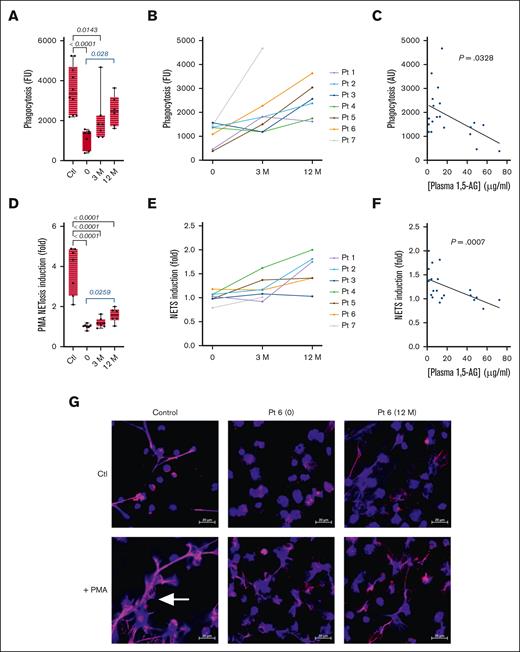 Effect of empagliflozin on phagocytosis and NETosis. (A-C) The phagocytic activity of freshly isolated neutrophils was determined in the 7 patients with GSD1b and 11 healthy donors at 3 time points using pH-sensitive particles of S aureus: (A) median ± quartiles of phagocytosis (fluorescence units) for the patients and controls, and (B) the individual profiles. (C) Spearman correlation analysis between plasma 1,5-AG concentration and neutrophil phagocytosis. (D-F) NET production determined by the quantification of extracellular DNA before and after PMA stimulation: (D) median ± quartiles of NETosis induction for the patients and controls, and (E) the individual profiles. (F) Spearman correlation analysis between plasma 1,5-AG concentration and neutrophil NETosis. (G) Representative confocal images of NETosis based on the labeling of DNA (blue) and neutrophil elastase (pink). The scale bar represents 20 μM, and white arrows indicate NETs structures. Statistically significant differences between patients and healthy controls (black) were determined by ordinary 1-way ANOVA for unpaired data, whereas mixed-effect analysis for paired data was used to compare values at 3 and 12 months after the start of empagliflozin treatment with values obtained before the start of treatment (blue). For clarity, only P values <.5 are shown.