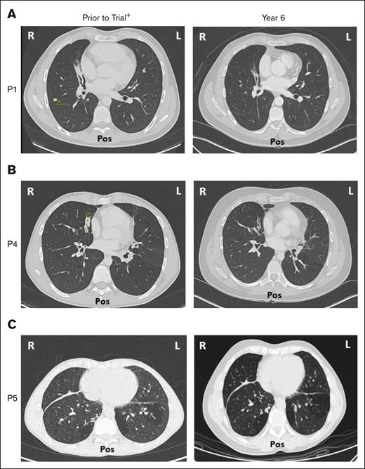 Bronchiectasis throughout treatment with leniolisib. Lung computed tomography scans from (A) P1, (B) P4, and (C) P5 who developed bronchiectasis before entry into the trial (left) and year 6 of treatment with leniolisib (right). L, left; Pos, posterior; R, right. +Images for P1 and P4 were taken ∼1 year before entry into the DFT, and the image for P5 was taken ∼4 years before exposure to leniolisib.