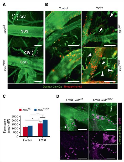 Jak2V617F mice showed an enhanced early endothelial adhesion of leukocyte and platelet in cerebral veins after CVST. (A) Intravital microscopy imaging of venous brain network from Jak2WT and Jak2V617F mice representing SSS and cortical venules (CtV) labeled with dextran 2 mKDa (green). Scale bar, 200 μm. (B) In sham-operated mice (left panel), sparse marginating leukocytes and platelets (rhodamine 6G, red) were found in Jak2V617F and Jak2WT mice. Two hours after CVST, adhesion and accumulation of platelets and leukocytes increased in both Jak2V617F and Jak2WT mice (right panel). Dextran imaging showed black segments within venules (white arrow), indicating a disruption in blood flow and formation of new thrombi. (C) Median of fluorescence intensity of rhodamine 6G–labeled platelets and leukocytes as a marker of thrombosis burden in CtV. Results are expressed as mean ± standard deviation (n = 5 per group). Data were analyzed using Kruskal-Wallis test; ∗P < .05; ∗∗P < .01. (D) Labeling of neutrophils (Ly6G, pink; lower panel) and vessels (dextran 2 mKDa, green; upper panel) showed that neutrophils were mainly involved in endothelial adhesion in Jak2V617F mice. Scale bars, 25 μm.
