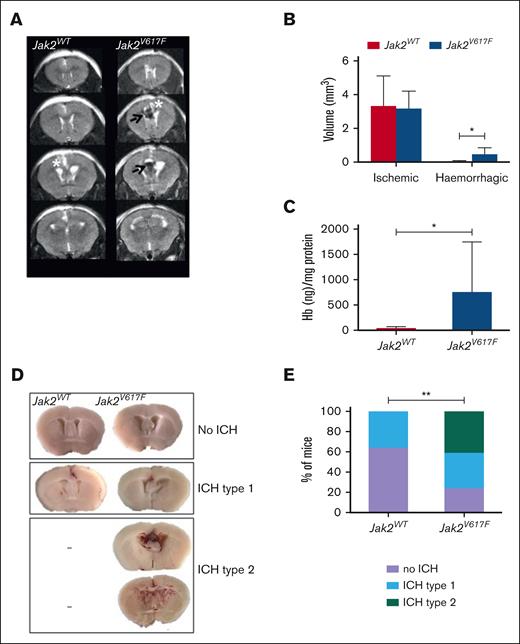 Jak2V617F mice displayed more CVST–related hemorrhagic lesions at day 1. (A) Representative serial coronal T2-weighted images from Jak2WT and Jak2V617F mice, 1 day after CVST induction demonstrating localized ischemia (white asterisk) and/or ICH (black arrow) in cortical parenchyma. (B) Brain lesions volumes (ischemic and hemorrhagic) determined from coronal T2-weighted images from Jak2WT and Jak2V617F mice at day 1, n = 5 per group. (C) Quantification of hemoglobin brain content at day 1 after CVST; ∗P < .05 (t test), n = 6 per group. (D) Brain slices from Jak2V617F and Jak2WT mice showing different pattern of ICH severity after CVST (no ICH; type 1: localized ICH; type 2: diffuse ICH). (E) Incidence of severe ICH (i.e., type 2) was significantly increased in Jak2V617F mice compared with Jak2WT mice at day 1 after CVST (n = 17 and 12 per group, respectively). In Figure 2B,C, data were analyzed using Mann-Whitney U test. In Figure 2E, data were analyzed by χ2 test; ∗P < .05.