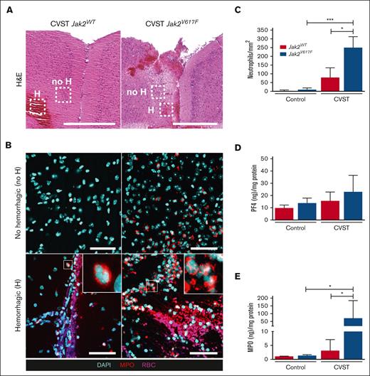 Brain neutrophil infiltration is increased in Jak2V617F mice after CVST. (A) Representative images of coronal brain sections taken through the area of damage from Jak2WT and Jak2V617F mice after CVST at day 1. Hematoxylin and eosin (H&E) staining showed the presence of hemorrhagic (H) lesions and nonhemorrhagic cortical parenchyma (no H) in dotted rectangles. Scale bar, 500 μm. (B) Corresponding brain images of staining for MPO (red); cell nuclei (DAPI, cyan) and red blood cells (RBCs, pink) in “no H” (upper panel) and “H” area (lower panel) from Jak2WT and Jak2V617F mice after CVST at day 11. Scale bars, 50 μm. (C) Bar graph indicated number of neutrophils within “no H” cortical parenchyma in sham and CVST mice (Jak2WT and Jak2V617F), n = 10 per group. Bar graphs indicated quantification of PF4 (D) and MPO (E) contents in whole brain from Jak2WT and Jak2V617F mice at day 1 in sham-operated and CVST mice, n = 5 to 6 per group. All results are expressed as mean ± SD. Data were analyzed by Kruskal-Wallis test followed by post hoc Dunn test; ∗P < .05 and ∗∗∗P < .01.