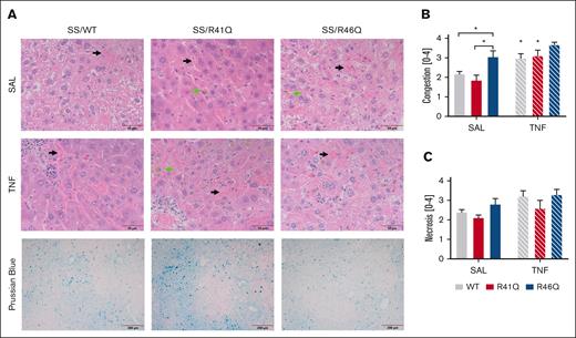 Hepatic congestion is enhanced in SSBM/R46Q mice. (A) Livers were collected and stained with H&E; representative images of livers from SSBM/WT, SSBM/R41Q, and SSBM/R46Q mice during steady state (SAL) and TNF-α challenge; scale bar represents 50 μm. Three blinded observers scored congestion (B) and necrosis (C). Data represent mean ± SEM. Black arrow denotes sinusoidal congestion, and green arrow denotes iron-laden macrophages. There were 6 to 8 mice (SAL, steady state) and 15 to 17 mice (TNF-α challenge) per group. Asterisks above bar represent statistical significance vs SAL-treated mice of same genotype by 2-way ANOVA and Tukey post hoc test. Asterisks above brackets indicate comparison. ∗P < .05. SAL, saline.