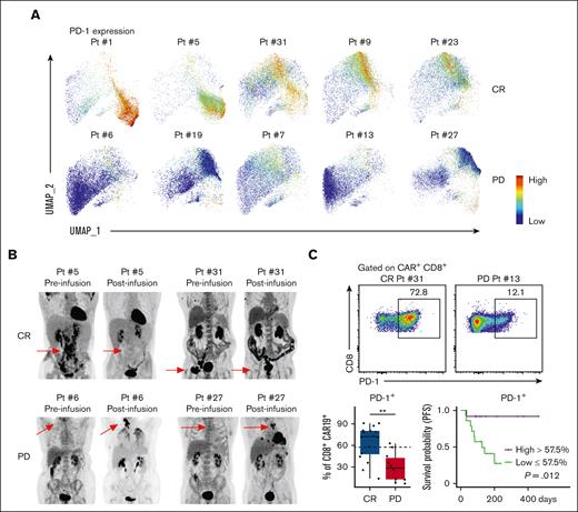 PD-1 expression on postinfusion CD8+ CAR-Ts correlates with improved clinical outcomes. (A) Individual patient PD-1 expression on CAR+ CD8+ T cells was plotted in the UMAP space; CR (top) vs PD (bottom). (B) Individual patient pre- and post-CAR-T infusion 18F-fluorodeoxyglucose–positron emission tomography (PET) scans. Preinfusion PETs were performed within 30 days of CAR-T infusion; red arrows point to site of preinfusion lymphoma lesions. Postinfusion PETs were performed 30 to 60 days after CAR-T infusion; red arrows point to areas of resolution or progression of lymphoma. (C) Representative 2D flow cytometry plot showing PD-1 expression in CR vs PD cohorts (top). Box plot showing percentages of PD-1+ CAR+ CD8+ T cells in CR vs PD cohorts (bottom left). KM analysis of PFS for patients with high (>57.5%) or low (<57.5%) percent of PD-1+ CD8+ CAR-Ts (bottom right); high group, n = 12; low group, n = 14. x-axis is time in days from date of CAR-T infusion. Dotted lines on box plots indicate separation lines between high and low percentages of CAR-Ts and were selected based on optimal response separation between cohorts. Because clinical outcomes were known during patient stratification, P values should be interpreted with caution. Box plots show quartiles with bands at the median; whiskers indicate 1.5 interquartile range; all observations overlaid as dots. P values are from linear regression analysis (cell type % changes) and log-rank test (PFS); ∗P < .05, ∗∗P < .01; ∗∗∗P < .001. Pt, Patient.