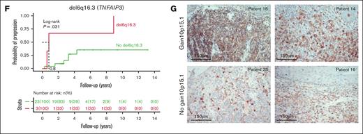 Correlation of genomic events to the disease stage. (A) Forest plot showing the association between individual genes alteration and clinical stage of MF divided into LR and HR, as depicted by OR. (B-E) Kaplan-Meier plots of individual genetic factors predictive of OS in univariate and multivariate models of 48 patients with a newly diagnosed MF: del10p11.22 (B); gain of 10p15.1 (C); gain of 7q (D); and del6q16.3 (E). (F) Kaplan-Meier curves for analysis of time to progression in patients with LR disease. P values were derived from log-rank test. (G) CD25 immunohistochemistry at diagnosis of MF skin biopsies in patients with gain of 10p15.1 (top panels, MF sample of patient 18 and patient 14 with presence of transformed MF cells) or without gain of 10p15.1 (bottom panels, MF sample of patient 23 and patient 16). Scale bars indicate 150 μm.