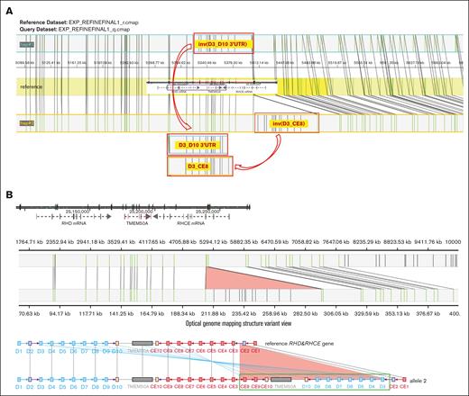 SV haplotype models of the proband generated by using Bionano OGM. (A) Models of the SV haplotypes of the proband (the red border boxes represent the SV regions). (B) Models of the distribution of Bionano labels between the reference genome and the sequenced sample in the RH gene region (the top figure presents the reference genome and the vertical lines on the axis indicate Bionano labels. The middle visualization depicts the Bionano analysis between the reference genome and the sequenced sample, with lines connecting the same label. The bottom part shows blue lines linking the reference genome with the corresponding exons of the proband. The light red triangle in the last 2 figures indicates the inserting region).
