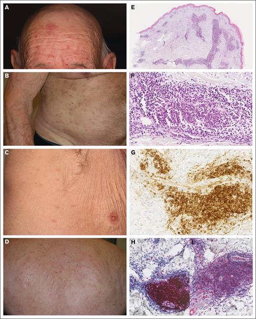 Clinico-pathological features of mature pDC dermatosis. (A-D) Papulo-nodular skin eruption in patients with pDC dermatosis. (E-F) Dense perivascular dermal infiltrate without blast cells (case 12; HES; original magnifications ×40 and ×330). (G) CD123 expression in mature pDCs (case 12; original magnification ×330). (H) TCF4 expression in mature pDCs (case 12; original magnification ×200). (I) CD2AP expression in mature pDCs (case 12; original magnification ×200). HES, haematoxylin, eosin, saffron.