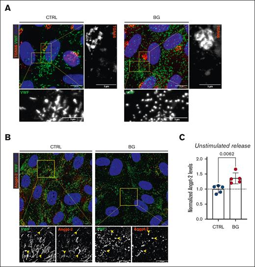 Effects of VWF OLG truncation on Golgi morphology and WPB cargo storage. (A) Immunofluorescent images of VWF (green), TGN46 (red), and DAPI (blue) of BG-treated HUVECs (2 mM for 72 hours) compared with untreated CTRLs (representative images of 2 independent experiments). (B) Immunofluorescence images of VWF (green), Angpt-2 (red), and DAPI (blue) of BG-treated HUVECs compared with untreated CTRL cells (yellow arrowheads indicate WPBs positive for Angpt-2; representative images of n = 5). (C) Angpt-2 levels secreted into conditioned media from BG-treated HUVECs compared with untreated CTRLs (n = 5; t test; P = .0062).
