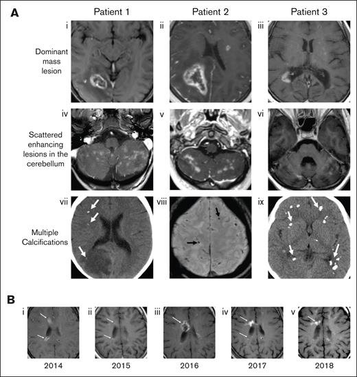 Characteristic radiographic findings of FANS and their evolution over time. (A) Representative MRI findings shown for 3 patients with FA in our cohort. (Ai-iii) Axial postcontrast T1-weighted MRIs show focal ring-enhancing mass lesions. (Aiv-vi) Contrast-enhanced images through the cerebellum show multiple enhancing lesions. (Avii,ix) Noncontrast computed tomography and (Aviii) susceptibility weighted MR images demonstrate multiple calcifications in each case (arrows). (B) Axial T1-weighted MR images from patient 3 over a 5-year span, demonstrating the waxing and waning of lesions. (Bi) In 2014, enhancing lesions are seen on the anterior and posterior margin of the right lateral ventricle (arrows), both of which markedly regress a year later (Bii, arrows). (Biii) In 2016, the anterior lesion recrudesces (arrow), then decreases again over the next 2 years, with some waxing and waning of the posterior lesion (Biv-v, arrows).