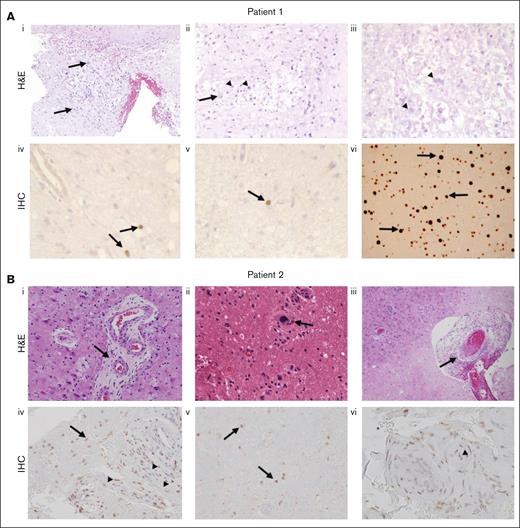 Brain biopsies from 2 patients with FANS. (A) H&E and immunohistochemical IHC stains of the brain biopsy of patient 1; (Ai) demonstrates a nonspecific necrotic-inflammatory reactive process with reactive astrocytes (arrows) and macrophages (arrowheads), 100×; (Aii) 200×; (Aiii) necrosis with minute flecks of mineralization (arrowheads). (Aiv-v) IHC staining of the brain biopsy of patient 1 with an antibody against SV40 T antigen that cross-reacts with JCV T antigen, demonstrating positive staining of scattered parenchymal cells (arrows). (vi) IHC staining of a positive control brain biopsy from a patient with progressive multifocal leukoencephalopathy (PML), showing more widespread staining of cells (arrows). (B) H&E and IHC stains of the brain biopsy of patient 2; (Bi-ii) abundant reactive appearing endothelium within many of the vessels, and necrosis, axonal spheroids, gliosis, abundant macrophages, and thick-walled hyalinized microvessels (arrows); (Biii) luminal occlusion (arrows); (Biv-v) IHC staining of the brain biopsy of patient 2 with an antibody against SV40 T antigen, demonstrating positive staining of scattered cells in the parenchyma (arrows) and the walls of blood vessels (arrowheads); and (Bvi) endothelial cells (arrowheads), more widespread than seen in patient 1. H&E, hematoxylin and eosin; IHC, immunohistochemical. JCV, JC virus. PML, progressive multifocal leukoencephalopathy. SV40, polyoma simian virus 40.