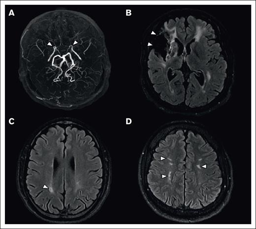 Brain MRI of lesions associated with SCD. (A) Maximal intensity projection reconstruction of a 3D-TOF MRA, showing occlusion of the distal segment of internal carotid arteries (arrowheads). (B-D) Axial 2-dimensional fluid attenuated inversion recovery (2D FLAIR), showing a territorial infarct (B, arrowheads), an isolated lacune (C, arrowhead), and white matter hyperintensities of presumed vascular origin (D, arrowheads).
