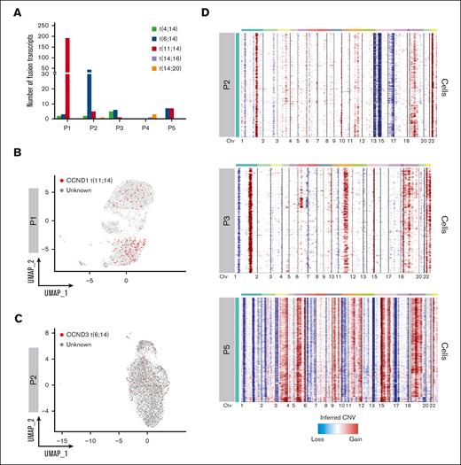 Geno-transcriptomic inference of MM subtypes by scRNA-seq. (A) Quantification of Fuscia fusion events across patients and translocation types. (B-C) t(11;14) and t(6;14) fusion transcripts mapped on P1 and P2 UMAP, respectively. The cells characterized by fusion transcripts are highlighted by red dots. (D) CNAs analysis of exemplary patients P2, P3, and P5, not characterized by different dominant clonotypes.