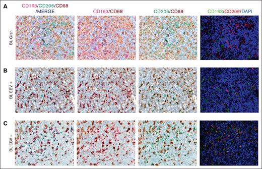 Multiplex immunostaining to validate M1 and M2 polarization. In BL granulomatous cases, the fraction of macrophages was significantly high, with a lower density of M2/TAM polarized macrophages (A). Conversely, BL with starry sky pattern, both EBV+ (B) and EBV– (C) showed an higher density of M2 macrophages. Original magnification, ×40.