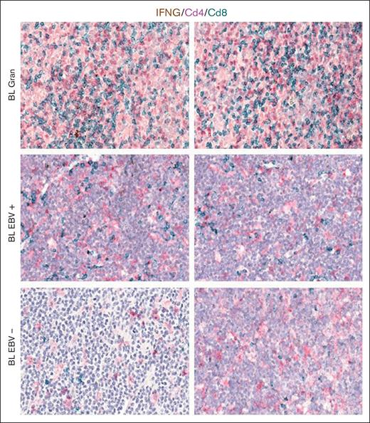 mRNA in situ hybridization for IFNG and immunohistochemistry (IHC) of CD4 and CD8. Representative microphotographs and quantitative analyses of mRNA in situ hybridization for IFNG and IHC for CD4 and CD8 showing the increase in the prevalence of CD8+ cytotoxic lymphocytes expressing IFNG in BL case. Original magnification, ×200 and ×400.