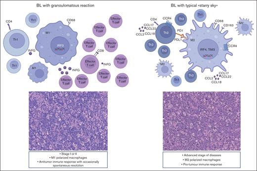 BL can show 2 different biological and clinical settings. M1 polarized macrophages prevail, and the immune response may be able to control neoplastic growth. In contrast, in cases characterized by the starry sky pattern, M2 macrophages dominate and may be responsible for a protumor immune response, resulting in disease rapid progression and dissemination.