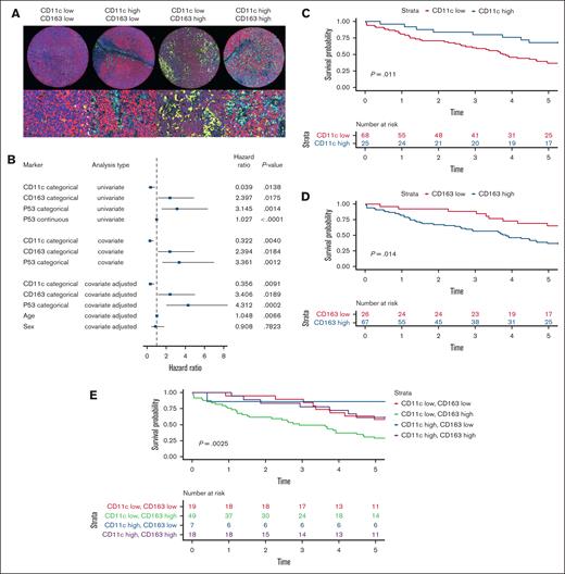 CD163 and CD11c are independent prognostic markers in MCL. Multiplex IF staining of CD20, CD11c and CD163 was performed. (A) Examples of MCL TIMEs with either CD11clow/CD163high, CD11clow/CD163high, CD163high/CD11high, or CD11chigh/CD163low (from left to right) are shown. (B) The prognostic value of CD11c, CD163, and p53 was investigated in univariate and multivariate Cox regression analyses. The Kaplan-Meier curve analysis and log-rank test showed the prognostic value of CD11c (C) and CD163 (D) as individual markers and the combined effect of CD11c and CD163 (E).