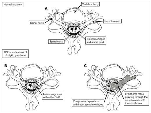 Defining CNS involvement. (A) Normal anatomy of the spine and surrounding anatomic structures. (B) Tumor originating within the spinal cord. (C) Tumor infiltrating through the neuroforamen, compressing the spinal cord.