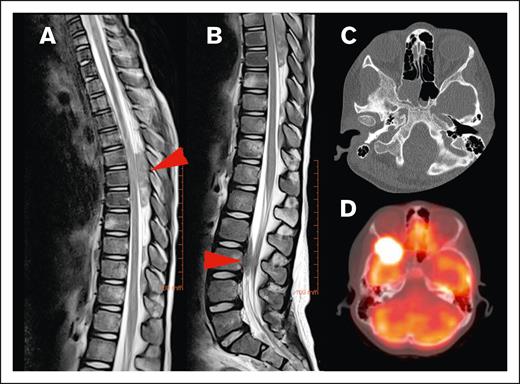 Locations of HL CNS involvement. (A) Tumor in the dorsal part of the thoracic spinal canal and (B) ventral part of the lumbar spine (T2-weighted MRI sequences of the same patient, red arrow indicating tumor location), (C) tumor originating from the skull (bone window with subtle osteolysis, and (D) PET-fusion demonstrating the same lesion as in panel C extending into orbit and middle cranial fossa.
