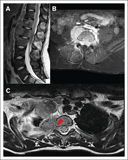 Different origins of CNS HL lesions. (A) Tumor originating from bone (vertebral body of T12, L1, and L2). (B) Unclear tumor origin but very likely bone, with circumferential involvement and an associated soft tissue component. (C) Paravertebral tumor mass of the upper thoracic spine infiltrating through the right neuroforamen, demonstrated by the red arrow, likely originating from soft tissue.