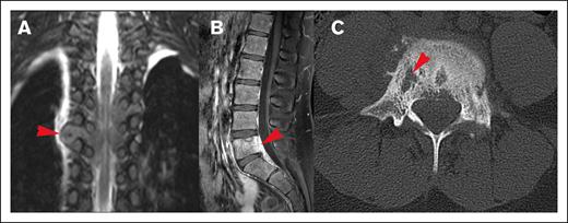 Spreading pattern of CNS HL. (A) Tumor spreading through the neural foramina into the thoracic spine. (B) Direct spread from lumbar spinal vertebrae, (C) Lytic cortical bony lesions (same patient as shown in panel B).