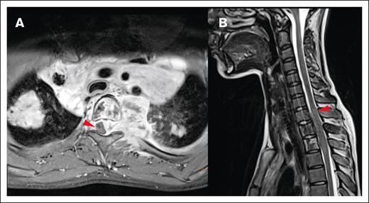 Local impact on CNS structures. (A) Displacement and mild compression of spinal cord to the right without contrast enhancement in the transverse T1 fat saturated image. (B) The same patient with edema clearly visible in the spinal cord in a sagittal T2-weighted MRI image.