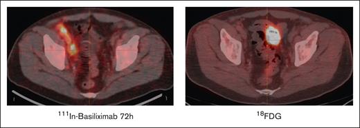 Biodistribution of 111In-basiliximab at 72 hours (left) and 18F-FDG-PET (right). There is positive uptake in right external iliac/obturator and right inguinal areas as seen on the basiliximab scan but there was no 18FDG uptake in the area.