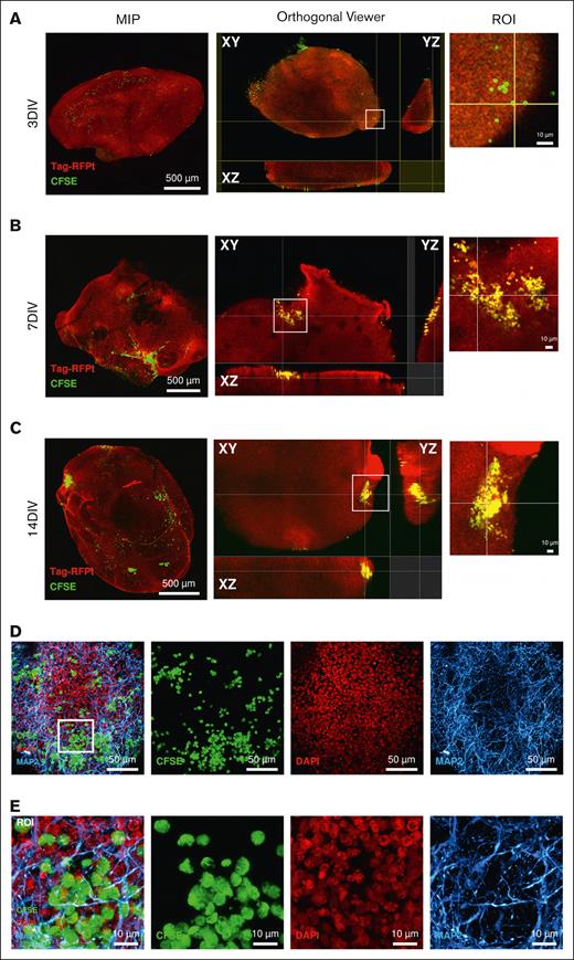 Deep invasion of TCF3::PBX1+ BCP-ALL cells into cerebral organoids occurs after 14 days of coculture. Cerebral organoids were cultured with (10 000) CFSE-stained TCF3::PBX1+ PDX cells. (A-C) Maximum intensity projections (MIP) are shown on the left-hand column, showing the DAPI (4’,6-diamidino-2-phenylindole) and monomeric tag red fluorescent protein tandem colocalizing with the cells’ CFSE signal. Orthogonal views on the right-hand column indicate the position of cells (green dots) by visualizing the organoid in 3 dimensions (XY, ZY, and ZX). Areas of leukemia cells found on the surface or within the organoid itself are shown in the orthogonal viewer and enhanced by the region of interest (ROI) image. (D) Subsurface CFSE-stained leukemia cells localize with other neuronal cell types. (D-E) Collapsed z-stack and merge of CFSE, DAPI, and anti-MAP2 staining are shown. Magnified images provide enhanced details of the leukemia cells colocalizing with the organoid volume (ROI), indicating that the leukemic cells sit in a complex network of neurons and their axonal/dendritic connections. Scale bars: 10 μm, 50 μm, and 500 μm.