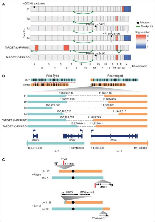WGS analysis of t(7;12)(q36;p13) AML. (A) Copy numbers (blue, loss; red, gain), structural rearrangements (green bow connecting 2 chromosomes), and mutations in known AML driver genes for 6 t(7;12)(q36;p13) AML samples based on WGS. Samples T1, T2, T3, and T4 were profiled in this study, whereas TARGET-20-PARUNX and TARGET-20-PASIBG are from the TARGET-AML cohort 15. (B) Sketch of the rearranged chr7 and chr12 and zoom-in on the region around the break points. (C) Schematic overview of chr7 (turquoise), chr12 (orange), and derivative chromosomes der(12) and der(7) resulting from the reciprocal t(7;12) translocation involving MNX1 on chr7 and ETV6 on chr12. Red lines indicate positions of break/fusion points.