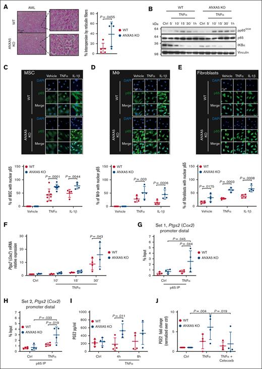 ANXA5 deficiency in the BMM results in acceleration of AML via establishment of a proinflammatory BMM and activation of NF-κB. (A) Representative images of bone sections from WT or ANXA5 KO recipient mice with MLL-AF9–induced AML (retroviral transduction/transplantation model) stained for reticulin (left) and its quantification (right). Nuclei were counterstained with nuclear fast red-aluminum sulfate solution (P = .0455; t test; n = 5). The scale bar represents 50 μm. (B) Representative immunoblot for pp65S536 (∼62 kDa), p65 (60 kDa), nuclear factor of kappa light polypeptide gene enhancer in B-cell inhibitor α (IκBα; 36 kDa), and vinculin (124 kDa) as housekeeping control performed on lysates from WT or ANXA5 KO MSCs treated with TNF-α (15 ng/mL) for the indicated times (n = 4-5). (C-E) Representative immunofluorescence images (top) and quantification (bottom) of primary WT (red) or ANXA5 KO (blue) MSCs (C), macrophages (Mϕ) (D) and fibroblasts (E) treated with TNF-α (15 ng/mL) or IL-1β (10 ng/mL) for 5 minutes, stained with an antibody to p65 (green) and DAPI (blue) (2-way ANOVA, Sidak test, n = 4). (F) Relative expression of prostaglandin-endoperoxide synthase 2 (Ptgs2; COX2) by quantitative real time polymerase chain reaction analysis in WT (red) vs ANXA5 KO (blue) MSCs treated with TNF-α (15 ng/mL) for the indicated times (P = .043; 2-way ANOVA; Sidak test; n = 4). (G-H) Binding of p65 to the promoter of Ptgs2 (COX2) in WT (red) or ANXA5 KO (blue) MSCs treated with TNF-α (15 ng/mL) vs vehicle for 30 minutes in a chromatin immunoprecipitation assay using 2 different primer pairs: set 1 (G) and set 2 (H) (2-way ANOVA; Sidak test; n = 4). (I) Levels of PGE2, measured by enzyme-linked immunosorbent assay (ELISA), in the conditioned medium of WT (red) or ANXA5 KO (blue) MSCs treated with TNF-α (15 ng/mL) for the indicated times (P = .011; 2-way ANOVA; Sidak test; n = 4). (J) Levels of PGE2, measured by ELISA, in the conditioned medium of WT (red) or ANXA5 KO (blue) MSCs treated with TNF-α (15 ng/mL) ± celecoxib (250 μM) for 4 hours (P = .004; P = .019; 2-way ANOVA; Tukey test; n = 4). The data are normalized over the control (vehicle). Ctrl, control.
