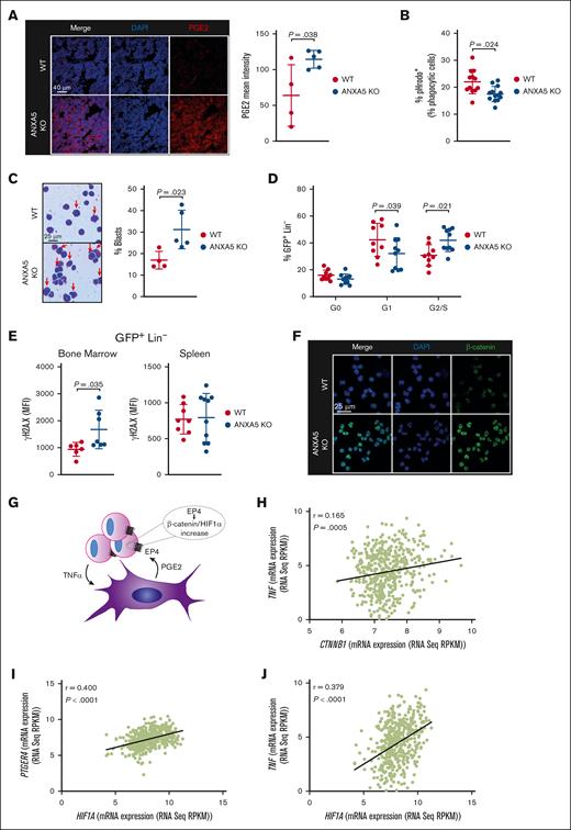 AML cells exposed to an ANXA5-deficient BMM show increased blasts and DNA damage. (A) Representative immunofluorescence images (left) and quantification (right) of bone sections from WT (red) or ANXA5 KO (blue) recipient mice with MLL-AF9–induced AML (retroviral transduction/transplantation model), stained for PGE2 (red) and DAPI (blue), on day 40 after transplantation (P = .038; t test; n = 4-5). The scale bar represents 40 μm. Four different fields from 4 individual mice were imaged; each dot represents the average per mouse. (B) Percentage of cells positive for phagocytosed, phycoerythrin-conjugated pHrodo Escherichia coli bioparticles of GFP (MLL-AF9)+ Gr1+ cells. The AML cells were taken from the BM of WT (red) or ANXA5 KO (blue) recipient mice with MLL-AF9–induced AML on day 40 after transplantation (P = .024; n = 12-13). (C) Representative images of Giemsa-stained cytospins of BM cells from WT (red) or ANXA5 KO (blue) recipient mice with MLL-AF9–induced AML (left) on day 40 after transplantation and quantification of the respective percentage of blasts of total leukocytes (right) (P = .023; t test; n = 4-5). The scale bar represents 25 μm. Four different fields from 4 to 5 individual mice were imaged; each dot represents the average per mouse. (D) Percentage of cells in the G0, G1, and G2/S phases of the cell cycle of GFP (MLL-AF9)+ Lin– cells. Cells were derived from the BM of WT (red) or ANXA5 KO (blue) recipient mice with MLL-AF9–induced AML on day 40 after transplantation (P = .039; P = .021; 2-way ANOVA; Tukey test; n = 9-10). (E) Median fluorescence intensity (MFI) of γH2A.X in GFP (MLL-AF9)+ Lin– cells in the BM (left) or spleen (right) of WT (red) or ANXA5 KO (blue) recipient mice with MLL-AF9–induced AML on day 40 after transplantation (P = .035; t test; n = 6-7). (F) Representative immunofluorescence images of nuclear β-catenin levels of GFP (MLL-AF9)+ Lin– cells sorted from the BM of WT or ANXA5 KO recipient mice with MLL-AF9–induced AML, stained for β-catenin (green) and DAPI (blue) on day 40 after transplantation (n = 4). The scale bar represents 25 μm. Four different fields from 4 individual mice were imaged; each dot represents the average per mouse. (G) Schematic representation of the proposed interaction between AML cells and cells of the BMM. AML cell–derived TNF-α stimulates increased production of PGE2 by cells of the BMM. PGE2 leads to increased expression of β-catenin and HIF-1α via its binding to the prostaglandin E receptor 4. (H) Correlation of the messenger RNA (mRNA) levels of TNF and CTNNB1 (β-catenin) in patients with AML. (I) Correlation of the mRNA levels of PTGER4 and HIF1A (HIF-1α) in patients with AML. (J) Correlation of the mRNA levels of TNF and HIF1A (HIF-1α) in patients with AML. The correlation analyses were performed using the data from the Oregon Health and Science University study by Verma et al,29 which was accessed via the cBioPortal. EP4, prostaglandin E2 receptor EP4; RNA seq, RNA sequencing; RPKM, reads per kilobase of transcript per million mapped reads.