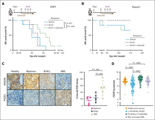 ANXA5-associated pathways may influence leukemia progression in human patients. (A) Kaplan-Meier style survival of NSG mice transplanted with 106 THP1 (MLL-AF9+) cells and treated with vehicle (blue), ara-C (50 mg/kg, 3 consecutive days as from day 14; purple) or the combination of ara-C (50 mg/kg, 3 consecutive days as from day 14) and celecoxib (50 mg/kg daily from day 10 for 1 week, then once every 3 days; green) (P = .047; P = .07; log-rank test; n = 7) (xenotranplantation model). Median survival for mice treated with vehicle was 40 days, for mice treated with ara-C was 45 days and for mice treated with the combination of ara-C and celecoxib 52 days. The reduced dosing of ara-C was used to allow for testing of possible synergistic effects of ara-C and celecoxib. (B) Kaplan-Meier style survival of NSG mice that received a transplant of 106 Kasumi (AML1-ETO+) cells and treated with vehicle (blue), ara-C (50 mg/kg, 3 consecutive days as from day 14; purple) or the combination of ara-C (50 mg/kg, 3 consecutive days as from day 14) and celecoxib (50 mg/kg daily from day 10 for 1 week, then once every 3 days; green) (n = 6) (xenotransplantation model). Due to the large number of mice that survived, median survival could not be defined. (C) Representative immunohistochemistry images of bone sections from healthy individuals, patients with multiple myeloma, B-ALL, and AML stained for ANXA5 (top) or PGE2 (bottom) (P = .009; P = .04; 2-way ANOVA; Tukey test; n = 5 per cohort). The quantification is shown on the right. The scale bar represents 25 μm. (D) Log2 expression of PTGER4, the prostaglandin E2 receptor 4 subtype, in BM cells of healthy individuals (n = 73) or patients with c–/pre–B-ALL t(9;22) (n = 122), pro–B-ALL t(11q23)/MLL (n = 70), or MLL-rearranged AML (n = 38), taken from the BloodSpot portal (Microarray Innovations in Leukaemia study31) (P < .0001; 1-way ANOVA; Tukey test).