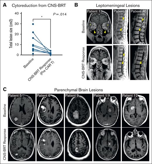 CNS-BRT response. (A) Paired lesion-size analysis shows a significant decrease in lesion size after CNS-BRT, before CAR T-cell infusion (P = .014). The mean decrease in lesion size was 74.8%. (B) Baseline imaging and CNS-BRT response for patients with leptomeningeal lesions. Patient 1: coronal T1 postcontrast MRI through orbits shows disease centered in bilateral superolateral extraconal fat (asterisks) and infiltrating the bilateral infraorbital nerves (arrowheads); 55 days after radiotherapy (RT) completion there is near complete resolution of orbital masses and decreased prominence of the infraorbital nerves. Patient 3: sagittal T1 postcontrast MRI of the lumbar spine demonstrating enhancing soft tissue mass filling much of the thecal sac from T12-L2; 19 days after RT completion there is marked decrease in intrathecal contrast enhancement (arrowheads). Patient 10: sagittal T1 postcontrast MRI of the lumbar spine showing enhancing soft tissue mass filling much of the thecal sac from T12 to superior extent of L2; 43 days after RT completion there is near complete resolution of the mass (arrowheads). Patient 3 and 10 had bulky spinal leptomeningeal lesions. (C) Baseline imaging and CNS-BRT response for patients with parenchymal brain lesions. All images show axial T1 postcontrast MRIs of the brain. Patient 5: enhancing lesion centered in the right occipital lobe shows significant reduction in size 2 days after RT completion. Patient 6: enhancing right frontal/operculum lesion shows significant reduction in size, 3 days after RT completion. Patient 9: enhancing paramedian lesion at the right frontoparietal convexity shows marked reduction in size, 42 days after RT completion. Patient 11: enhancing lesion centered in the left thalamus shows significant contraction, 4 days after RT completion. Patient 12: enhancing right gangliocapsular lesion shows near complete resolution, 5 days after RT completion.